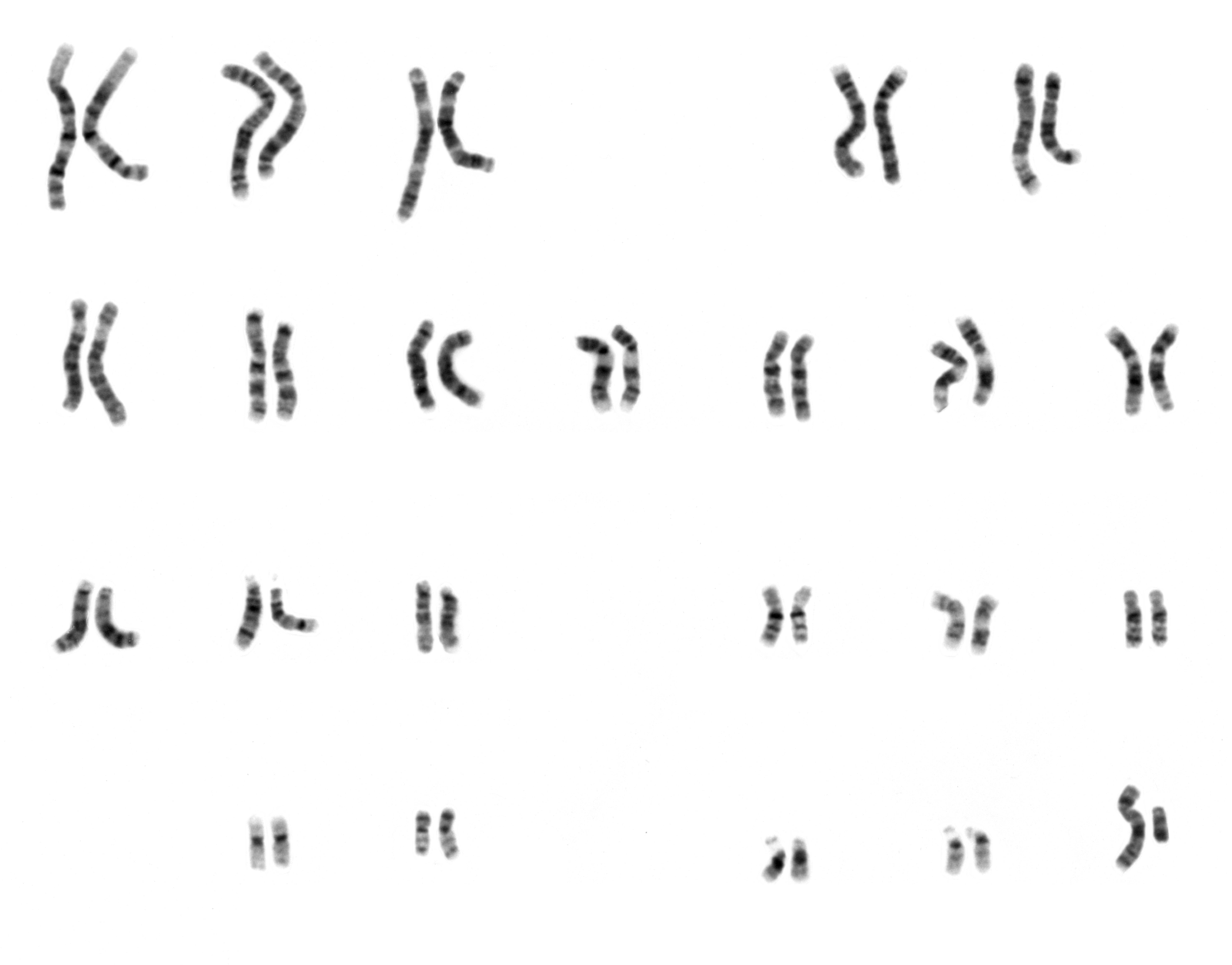 The 46 human chromosomes arranged in pairs